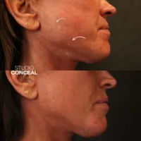acne scar revision tattoo