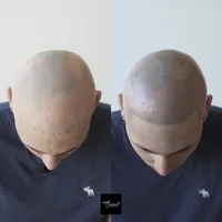 Alex-alopecia-copy