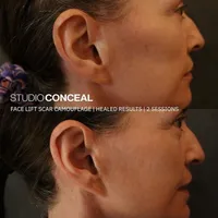 gilbert face lift scar tattoo