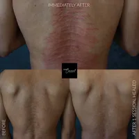 Male-stretch-marks-back-3