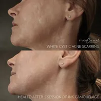 acne scar revision tattoo