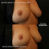 breast lift explant scar concealed