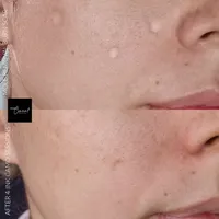 scar camouflage