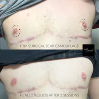 FTM SURGICAL SCAR MEDICAL TATTOO ARIZONA