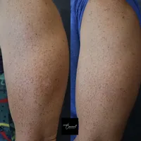 Jennifer-arm-2