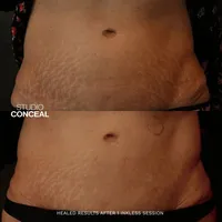 gilbert stretch mark removal