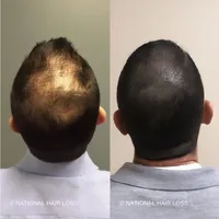scalpmicropigmentationinarizonabeforeafter