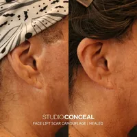 face-lift-scar-tattoo