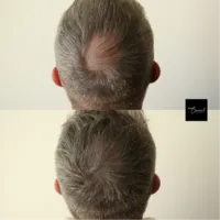 Hair-Loss-Density-Tattoo-3