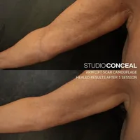 Arm-Lift-Scar-Camoufage-Tattoo