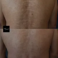 Male-stretch-marks-back-2