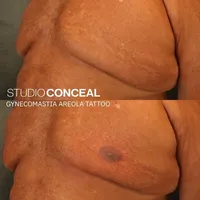 Gynecomastia-AREOLA-TATTOO