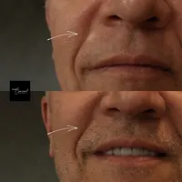 scar camouflage