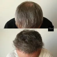 Hair-Loss-Density-Tattoo