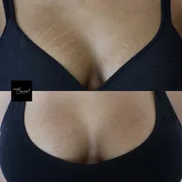 arizona-stretch-mark-removal-tattoo
