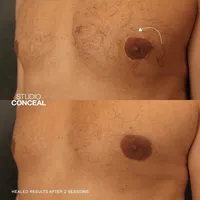 top surgery areola scar revision
