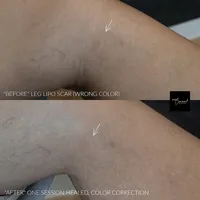 leg-lip-scar-camouflage-tattoo-3