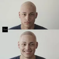 Alex-alopecia