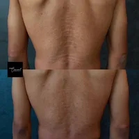 Male-stretch-marks-back-1