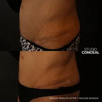 mesa stretch mark removal