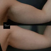 stretch-mark-arms-right-2-1