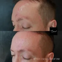 scar camouflage