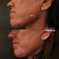 acne scar revision tattoo