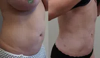 Abdominal and Flank Liposuction Waltho