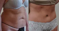 Abdominoplasty and liposuction of abdomen and flanks_Waltho