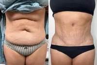 Tummy tuck and lipo
