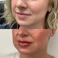lip filler correction