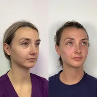Facial Balancing with Filler 2