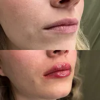 lip filler