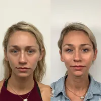 PRP Derma Filler 4