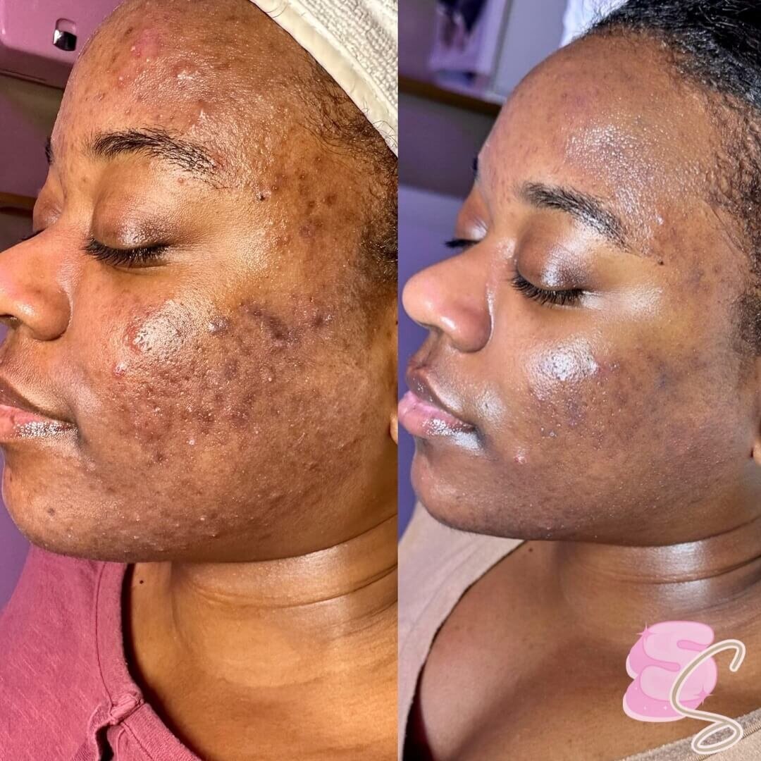 Acne bootcamp before _ after