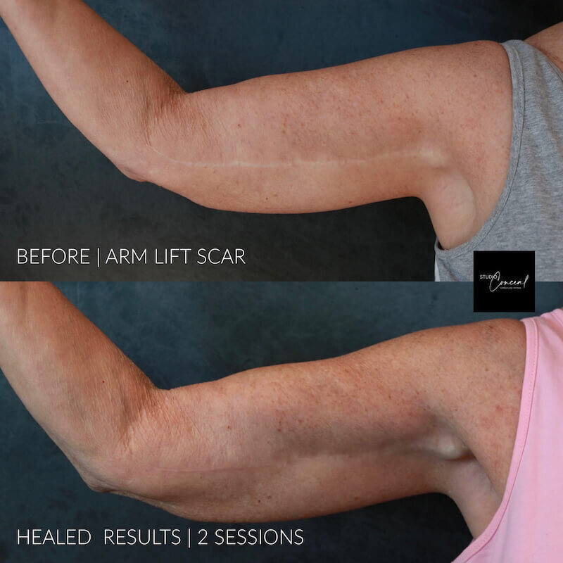 arm-lift-scar-camouflage-2 (1)