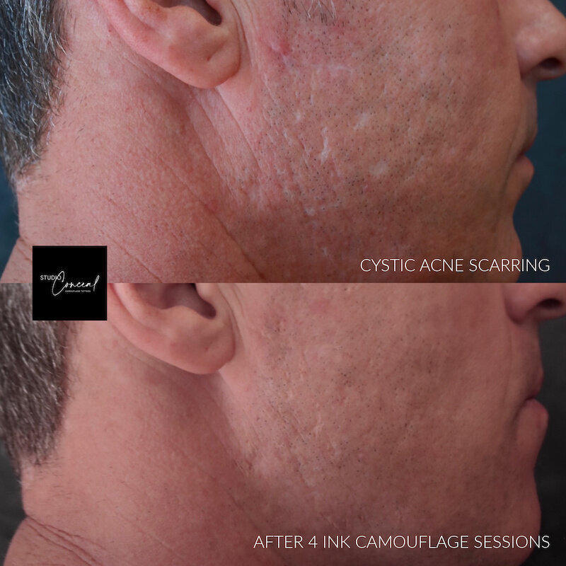  acne scar revision tattoo