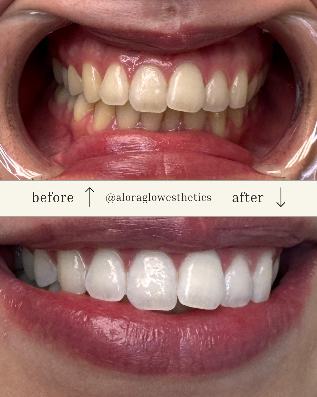 Sacramento-Teeth-Whitening-before-and-after-teeth-whitening-alora-glow-esthetics-4