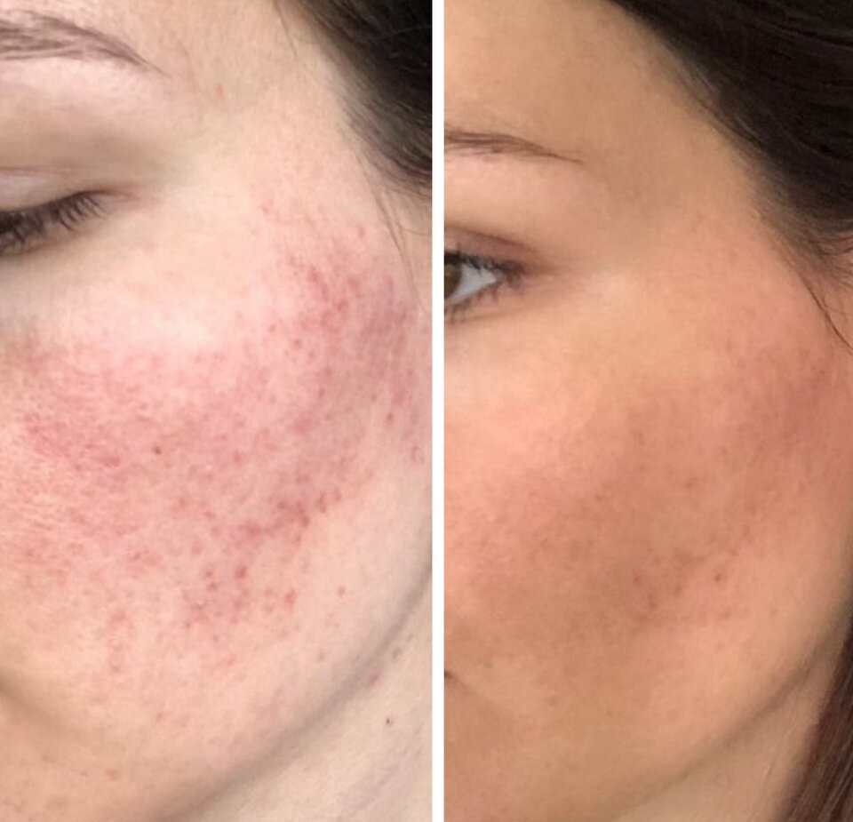 Rosacea flare-ups reduced by optimizing gut health and detoxing the liver naturally.