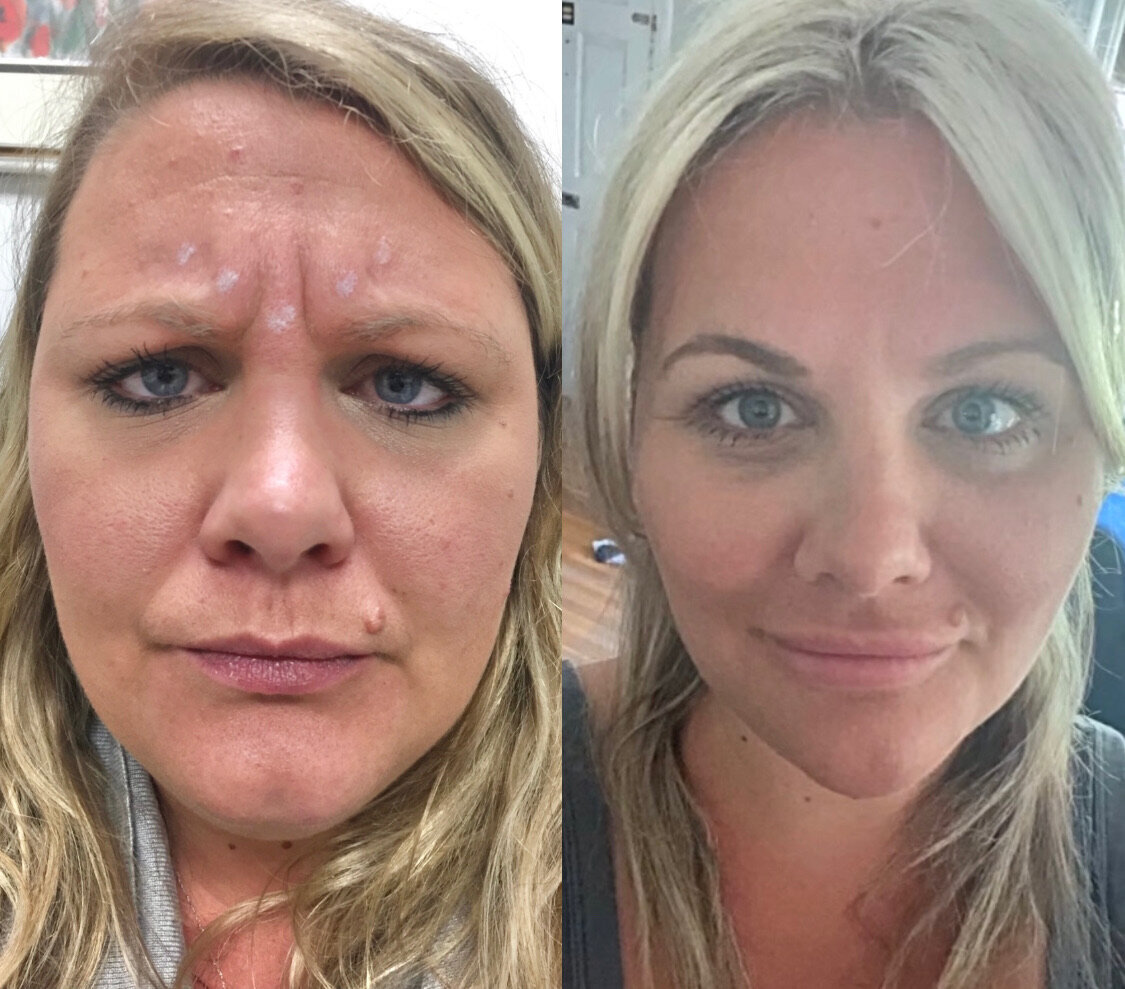 BalancedBeautyBotoxWestwood36