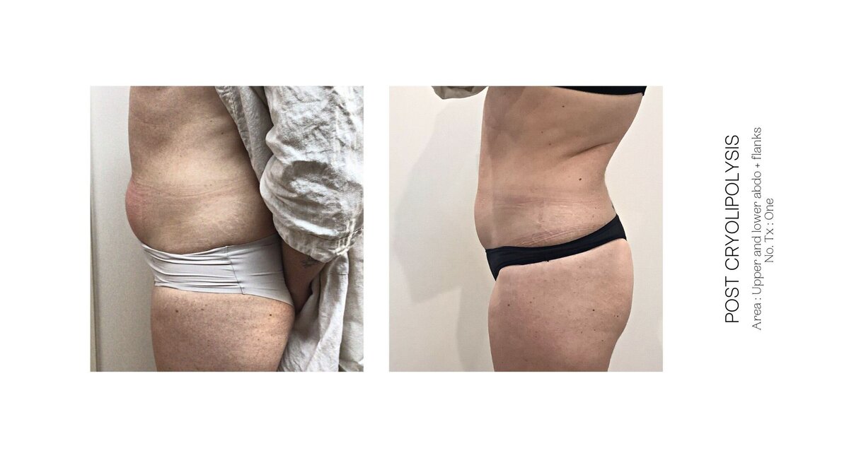 Cryolipolysis Stomach Before and After 5