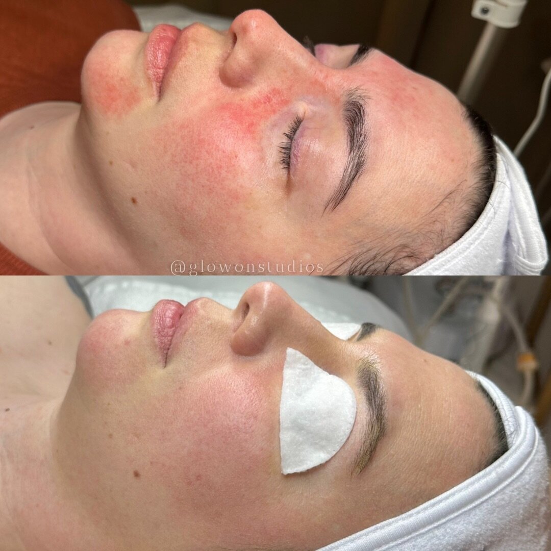 Glow-On-Studios-Before-After-Skincare-Sacramento-5