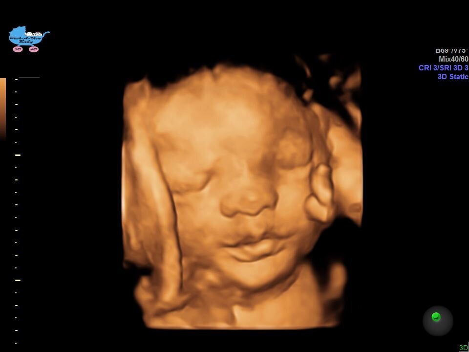 peek a belly 3d ultrasound lockport