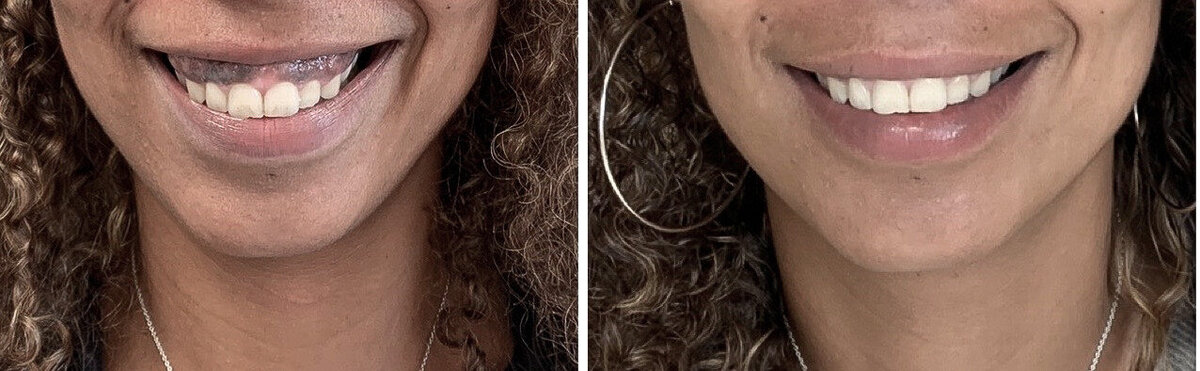 Botox gummysmile before after door cosmetisch arts Lizenka Adriaanse in Rotterdam