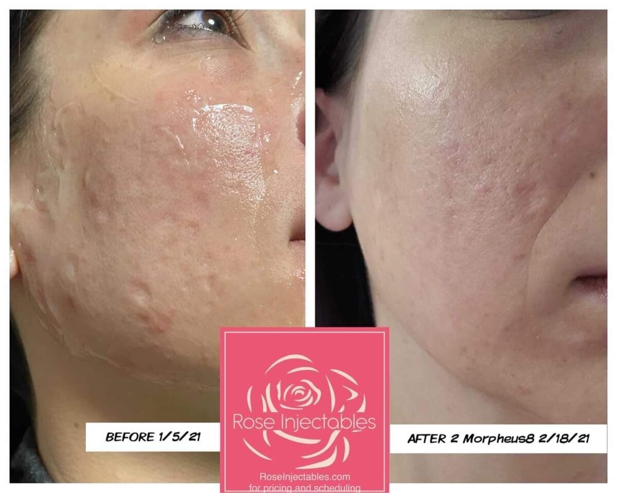Morpheus8-by-Rose-Injectables-Before-and-After-Photos-67