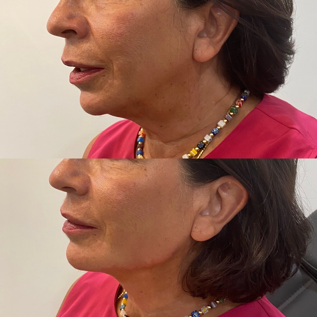 BalancedBeautyBotoxWestwood1