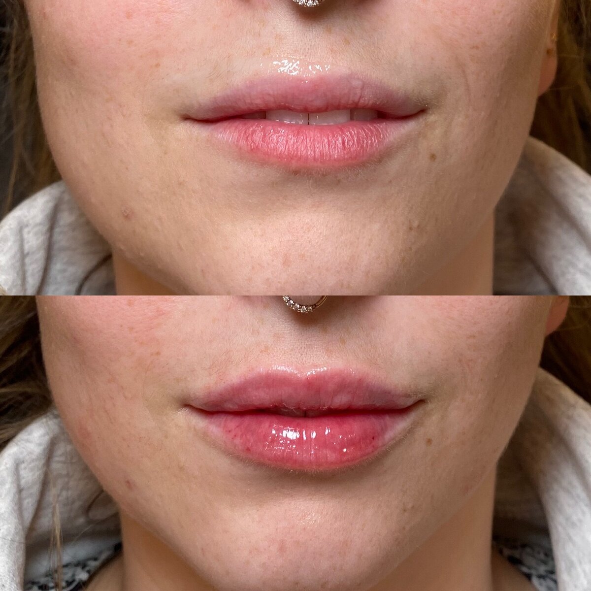 BalancedBeautyBotoxWestwood5