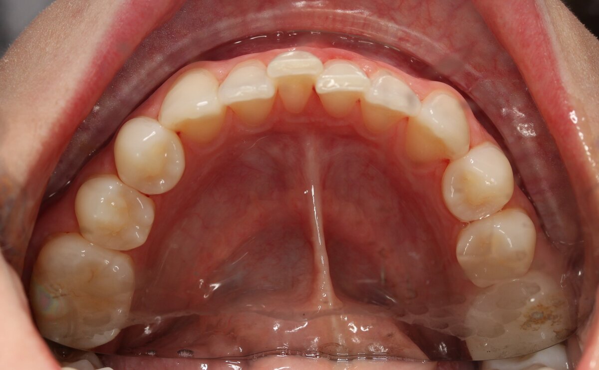 lower teeth crowded in Allen TX
