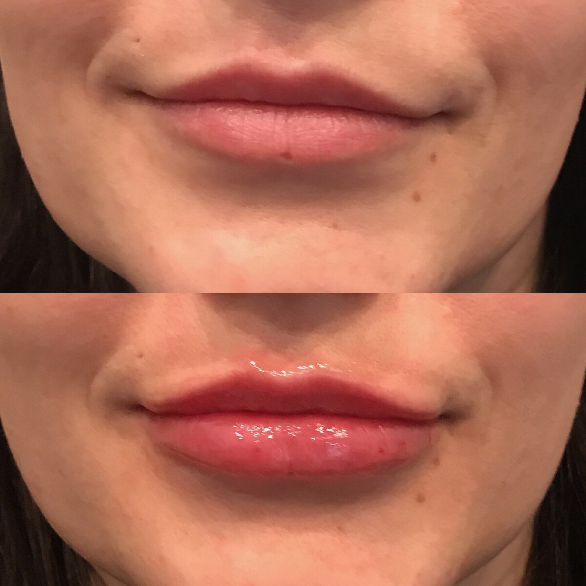 Lip hydration filler before after
