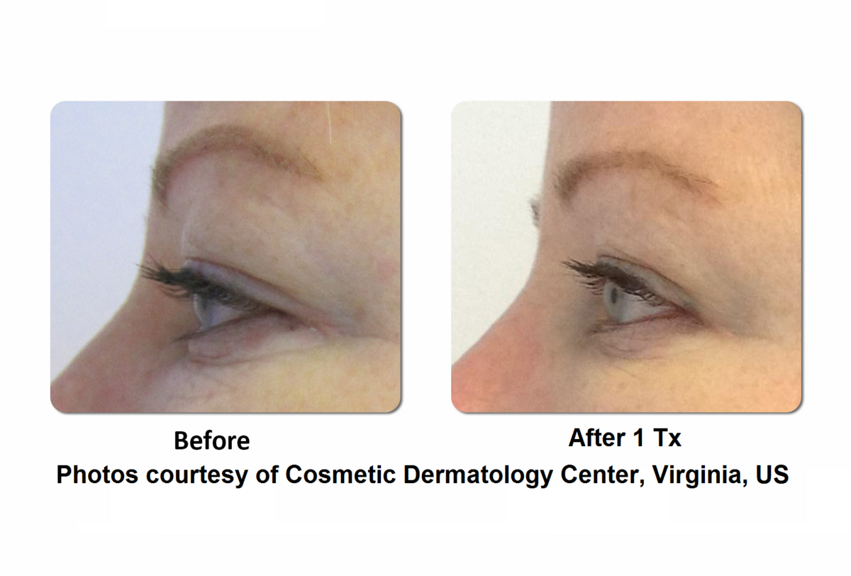 Li Medical Aesthetics Skin Tightening with VST Sinclair Before and After7
